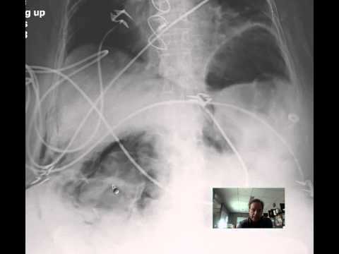 Free Air Riglers Sign Discussion by RADIOLOGIST