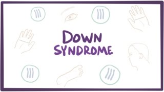 Down syndrome-causes, symptoms, diagnosis, & pathology
