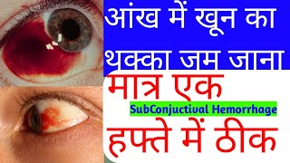 Subconjuctival Hemorrhage।Red spot in eye।आंख में खून जम जाना।Cause।Treatment।
