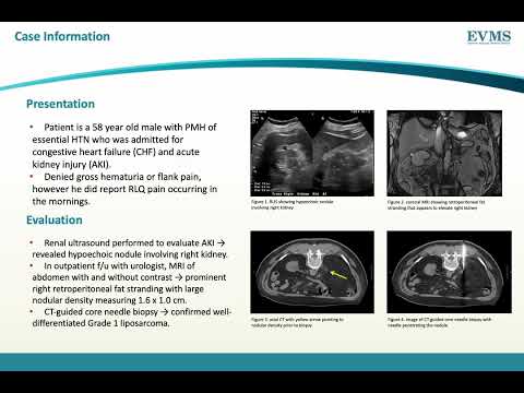 Thumbnail image of video presentation for Incidental Finding of a Retroperitoneal Liposarcoma