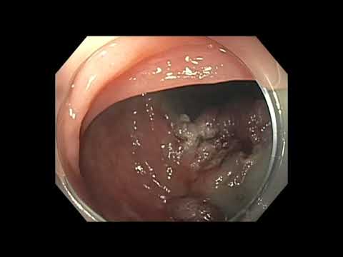 Colonoscopia - extirpación de un pólipo del sigmoide con antecedente de dos extirpaciones previas