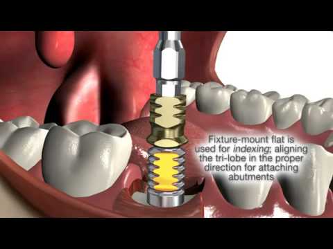comment se faire rembourser des implants dentaires