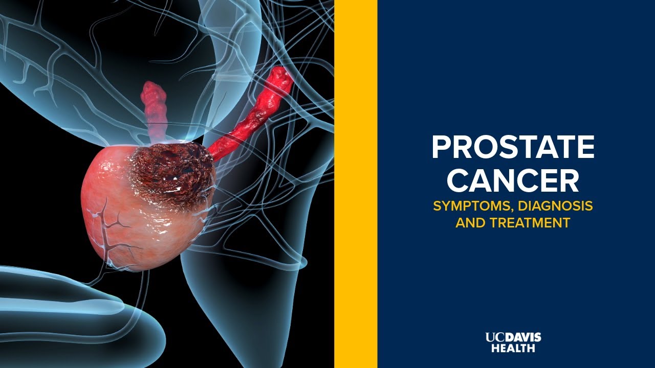 Thumbnail preview of Prostate Cancer - Symptoms, Diagnosis and Treatment Explained | UC Davis Health