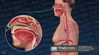 Nasogastric Tube Insertion