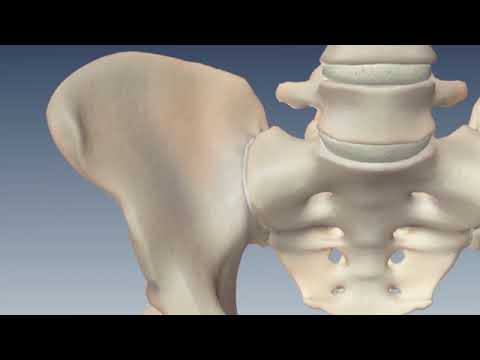 Sacroiliac Joint Fusion with the iFuse Implant System®