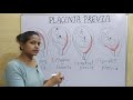 PLACENTA PREVIA ALL NURSING EXAMS l Placenta position during pregnancy l Placenta previa lecture