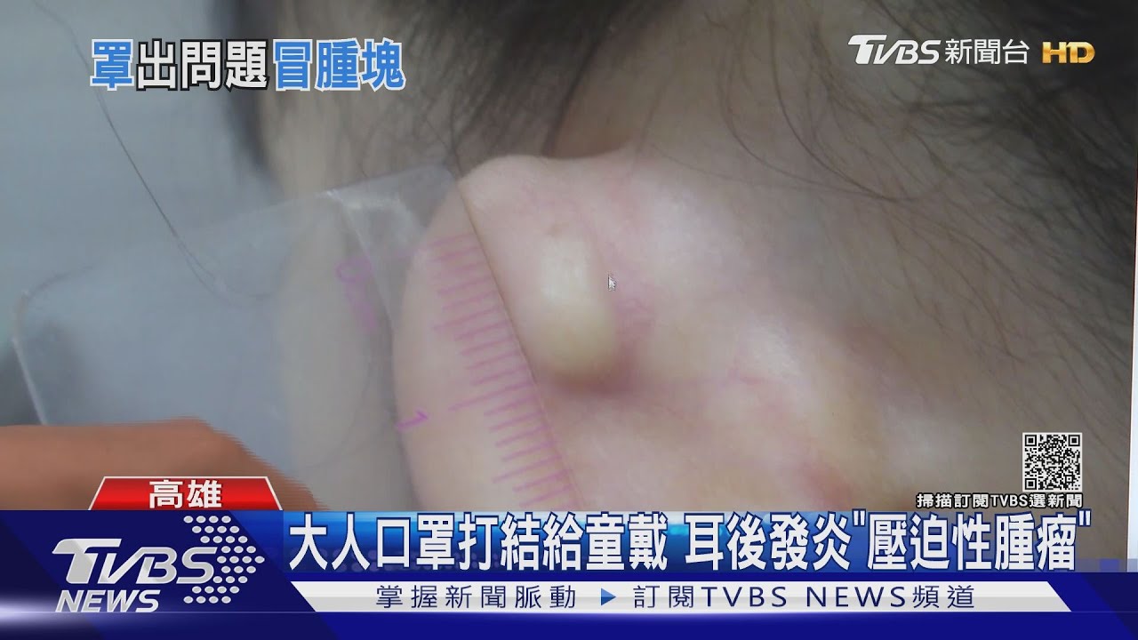 7歲女童戴大人口罩 耳後發炎長「壓迫性腫瘤」
