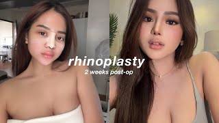 I GOT A NOSE JOB AGAIN | my rhinoplasty journey