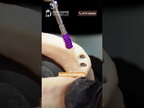 All-on-4: procedura completă de inserare a implanturilor dentare!