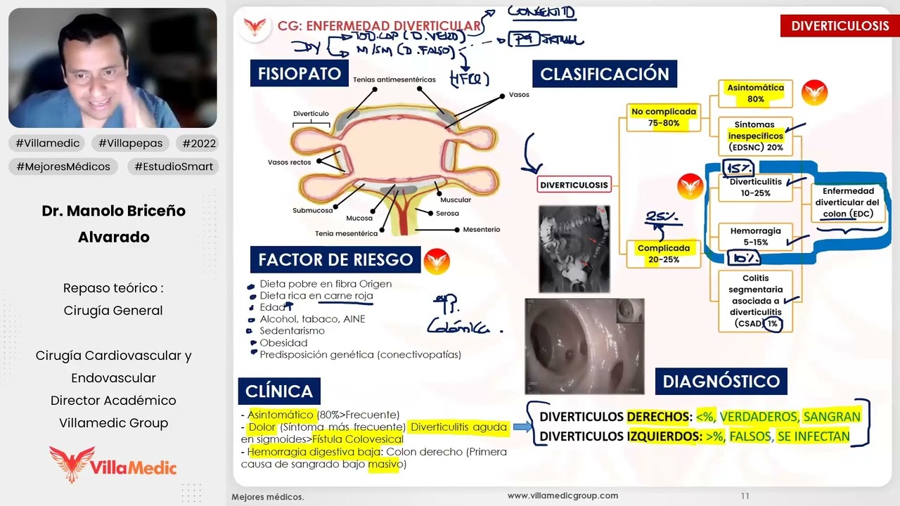 ENFERMEDAD DIVERTICULAR - CIRUGÍA GENERAL - VILLAMEDIC