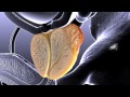 Prostate Cancer Animation
