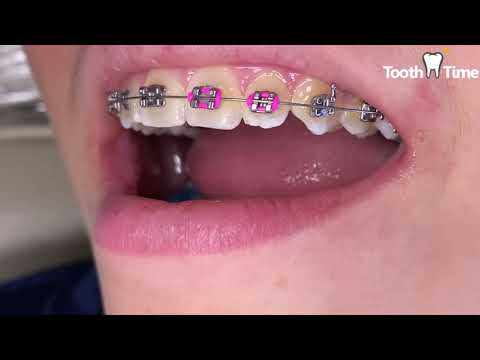 Braces check up - 014 NiTi Wire - Tooth Time Family Dentistry New Braunfels Texas