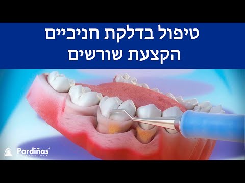טיפול בדלקת חניכיים – הקצעת שורשים ©