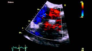 Patent Foramen Ovale - Transthoracic Echocardiogram (TTE)