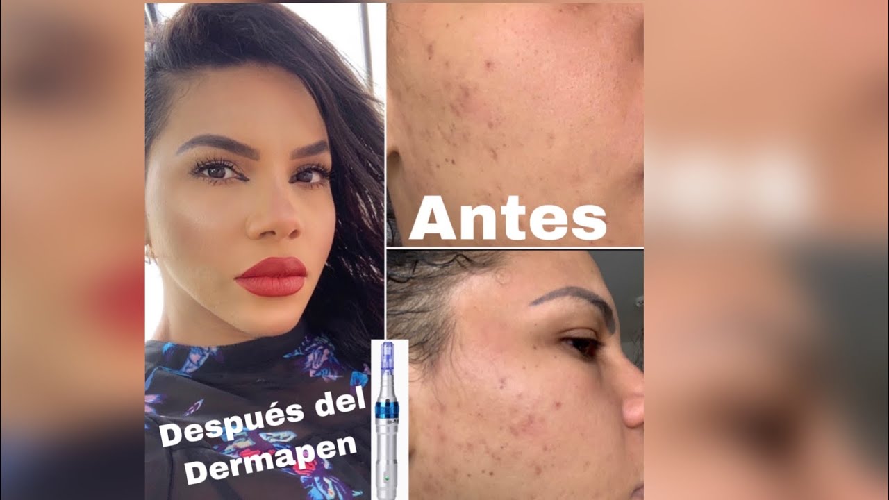 Watch Como usar el Dermapen en casa, para quitar manchas y cicatrices Now Como usar el Dermapen en casa, para quitar manchas y cicatrices