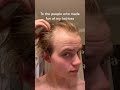 To the people who made fun of my hairloss