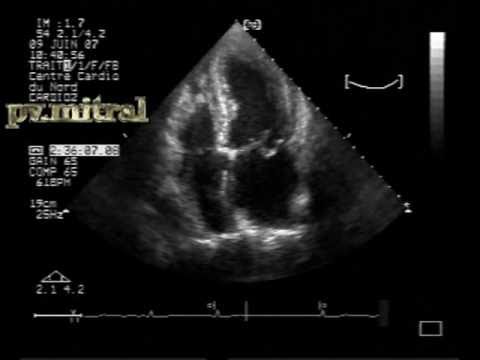 Mitral Valve Prolapse