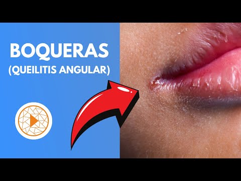 Angular cheilitis (or angular cheilitis) | How to cure it quickly and understand its causes