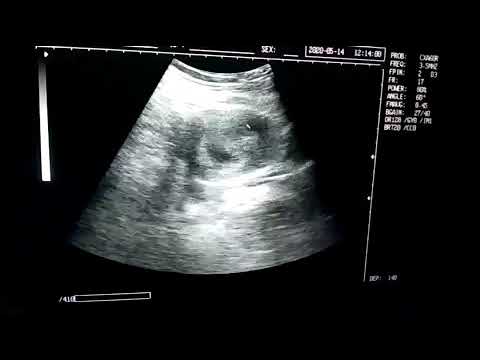 THIS IS WHAT A 7-WEEK GESTATIONAL EMBRYO LOOKS LIKE, 7-WEEK ULTRASOUND, 7-WEEK PREGNANCY