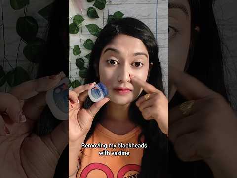Removing My Blackheads with Vaseline⁉️😱🤯