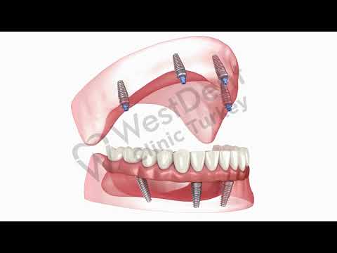 Logo of In-Depth Overview of the Full Arch Dental Implants Procedure in Izmir, Turkey