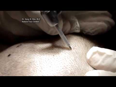 NeoGraft Hair Restoration Surgery in Syracuse - ABC News