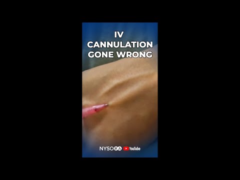 IV Cannulation gone wrong?