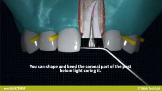 everStickPOST Individually formable glass fibre root canal post