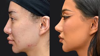 My 4th Nose Job Surgery Story! Nikita Dragun