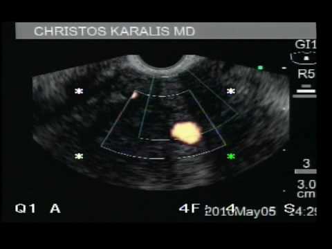 Lession In Pancreas - Ultrasound Endoscopy