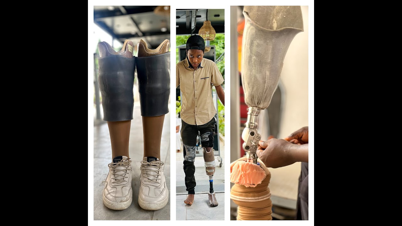 Steps of Hope: How Prosthetics Are Giving Nigerians a Second Chance