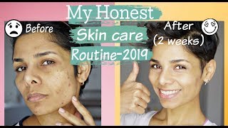 How to Get Rid of Acne, Discoloration and Uneven Skin Tone/ Skin Care Routine-2019