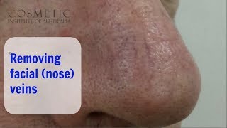 Radiofrequency removal of Facial (Nose) veins