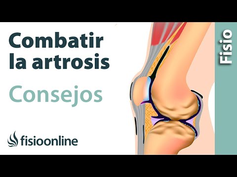 Artrosis: consejos y recomedaciones de un fisioterapeuta