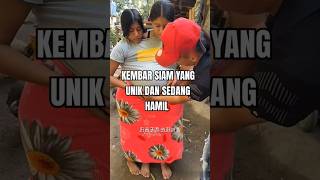 Download lagu These conjoined twins are pregnant #shorts #shortvideo mp3 Download lagu These conjoined twins are pregnant #shorts #shortvideo mp3