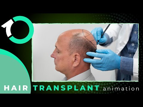 Sapphire FUE Hair Transplantation - Recovery & Aftercare - One Clinic Patient Review Video