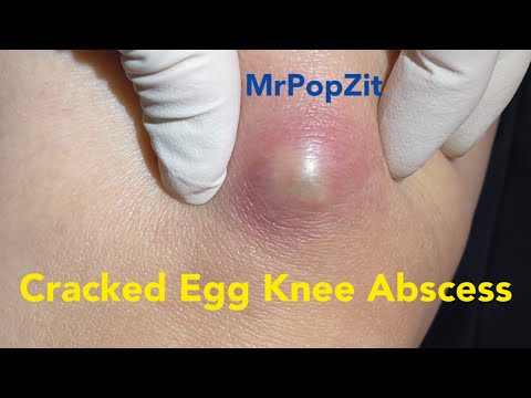 Cracked Egg Knee Abscess. Large mass on knee under pressure and painful. Pressure relieved.