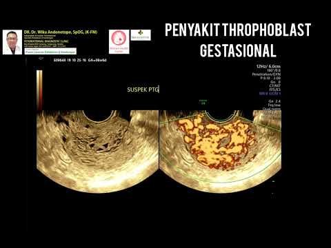 Penyakit Throphoblast Gestasional