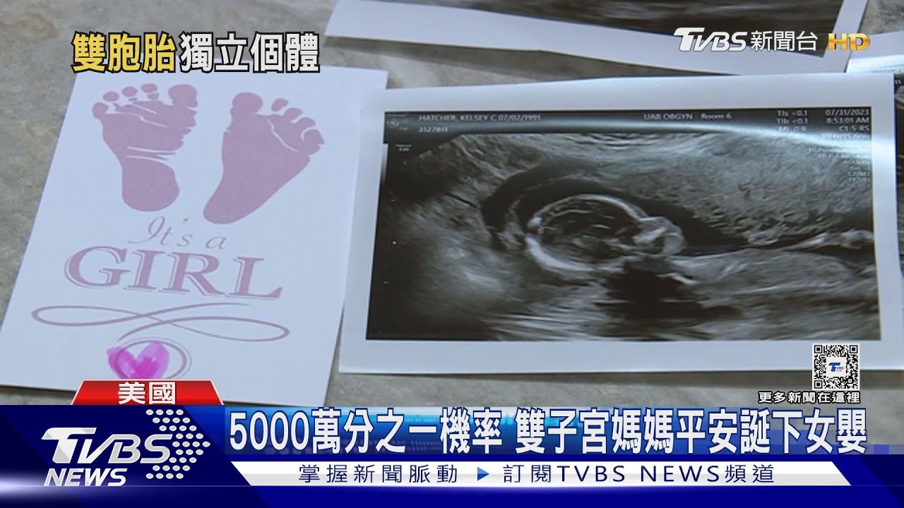 5000萬分之一機率　美婦女「雙子宮」同時懷胎產雙胞胎