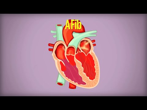 心房細動（AFib）と暮らす (Living with Atrial Fibrillation (AFib))