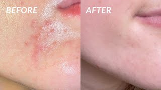 How I COMPLETELY got rid of my PERIORAL DERMATITIS in 4 DAYS! the secret cure.