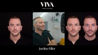 Full face fillers for #masculinity #jawlinefiller #fillers #masculine