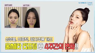 울쎄라 4주간의 변화 브이로그