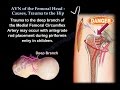 AVN Femoral Head  Causes, Trauma To The Hip - Everything You Need To Know - Dr. Nabil Ebraheim
