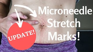 Microneedling STRETCH MARKS | Microneedling Stomach