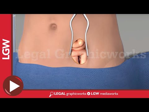 Anterior Lumbar Fusion Surgery L5 S1 3D animation