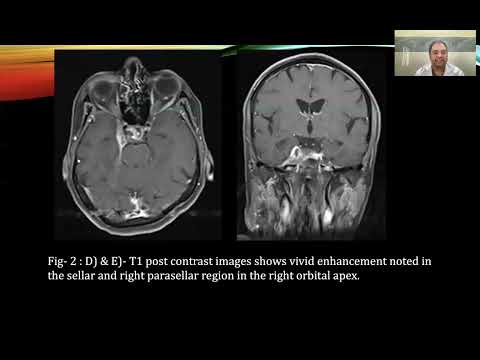 J Sai Tarani = A Rare Case of Painful Ophthalmoplegia