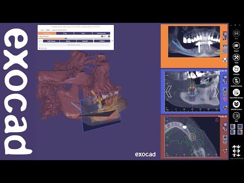 Come rimuovere linfiammazione delle articolazioni in osteoartrite Rimozione compresse da mal di schiena