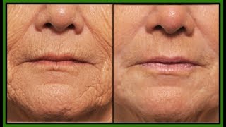 HOW TO GET RID OF DEEP MOUTH WRINKLES | HOW TO REDUCE AND REMOVE MOUTH WRINKLES | Khichi Beauty.