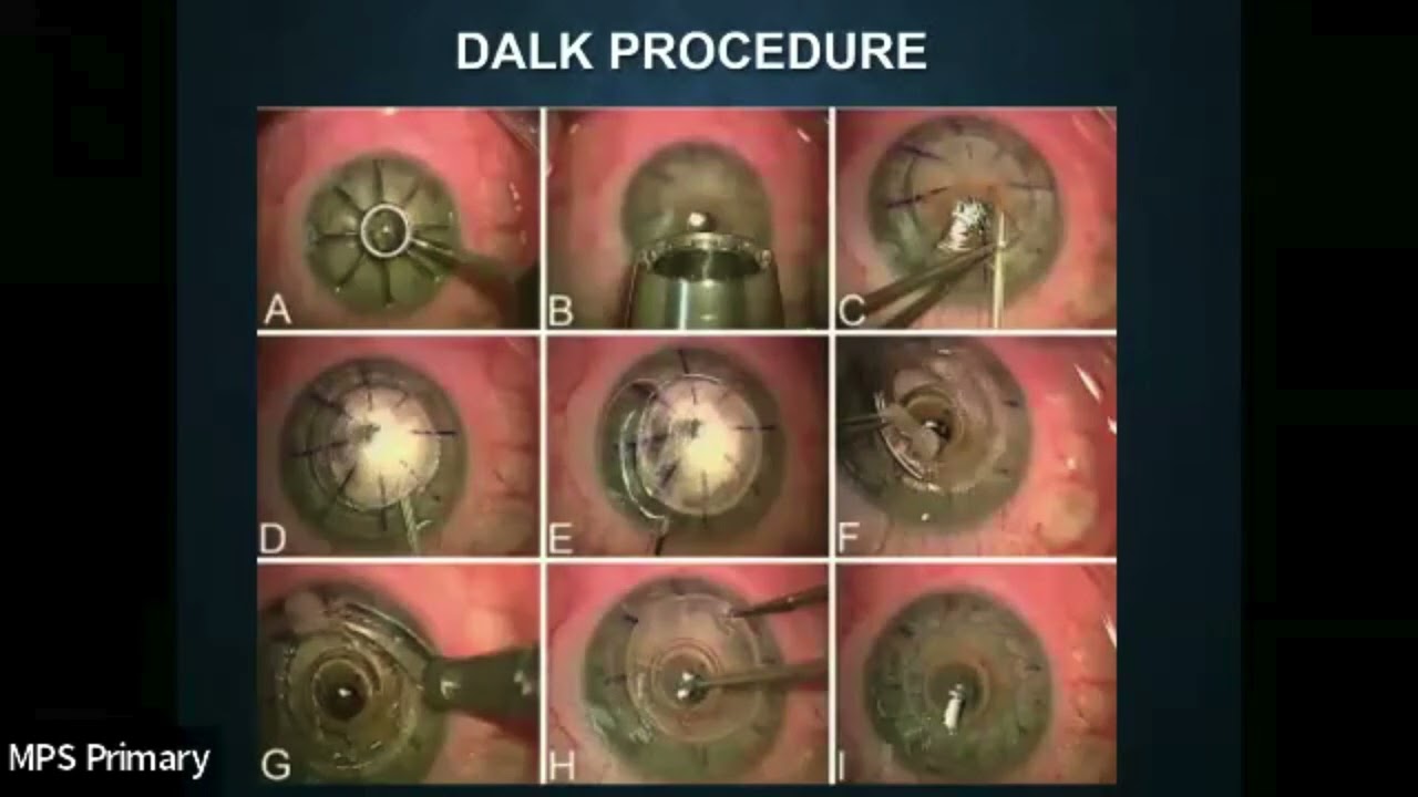 Corneal Transplants in MPS: Navigating Eye Care